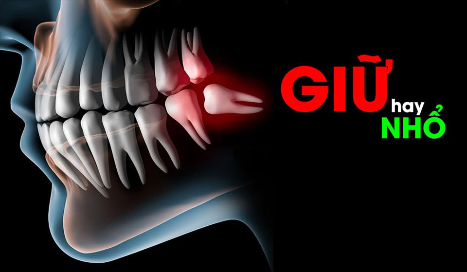 Nhổ răng khôn khó Nhổ răng khôn khó