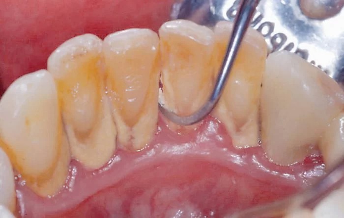 Cao răng là Cao răng là