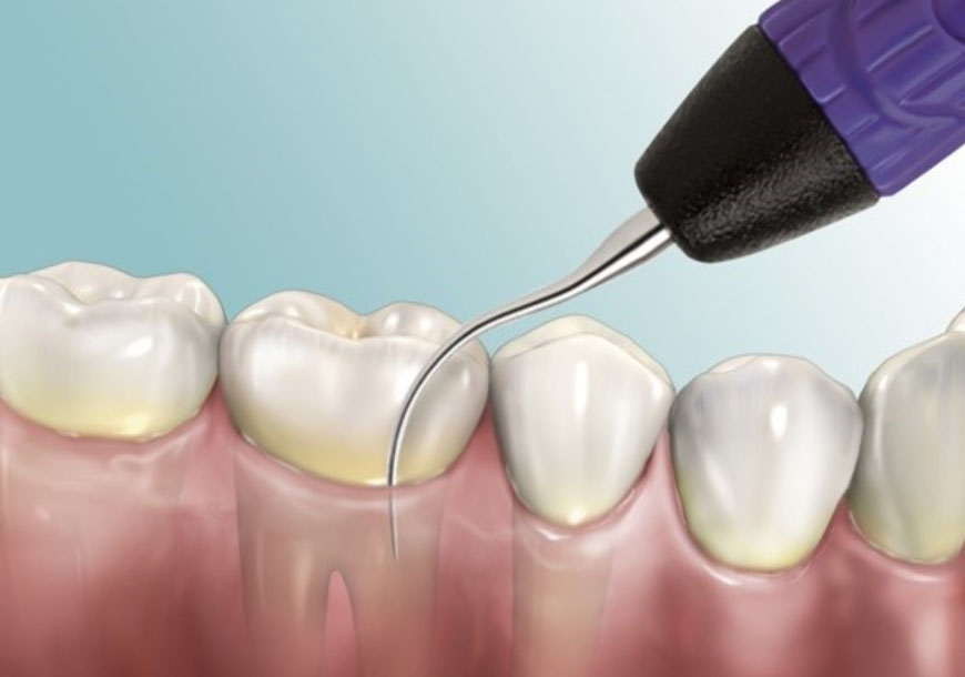 Cao vôi răng Cao vôi răng