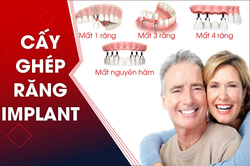 Cấy ghép răng implant tốt Cấy ghép răng implant tốt