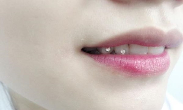 Đính đá vào răng tại nha khoa Hanseoul Đính đá vào răng tại nha khoa Hanseoul