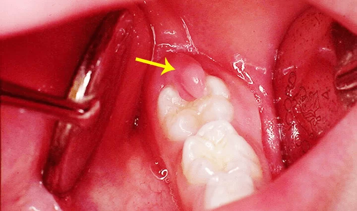 mọc răng khôn gây viêm lợi