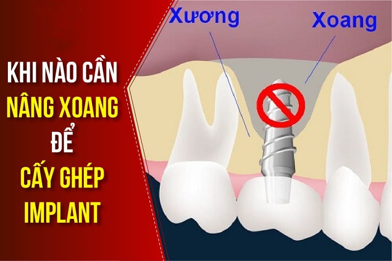 KHI NÀO CẦN NÂNG XOĂNG TRONG CẤY GHÉP IMPLANT