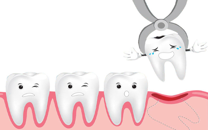 Lý do nên nhổ răng khôn Lý do nên nhổ răng khôn