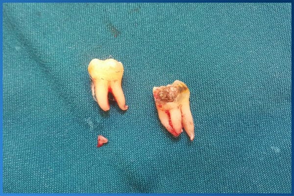 Nhổ răng khôn 4 cái