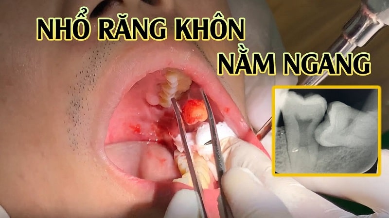 Nhổ răng khôn mọc ngang Nhổ răng khôn mọc ngang