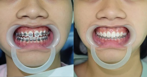 Niềng răng thưa có nên niềng răng không