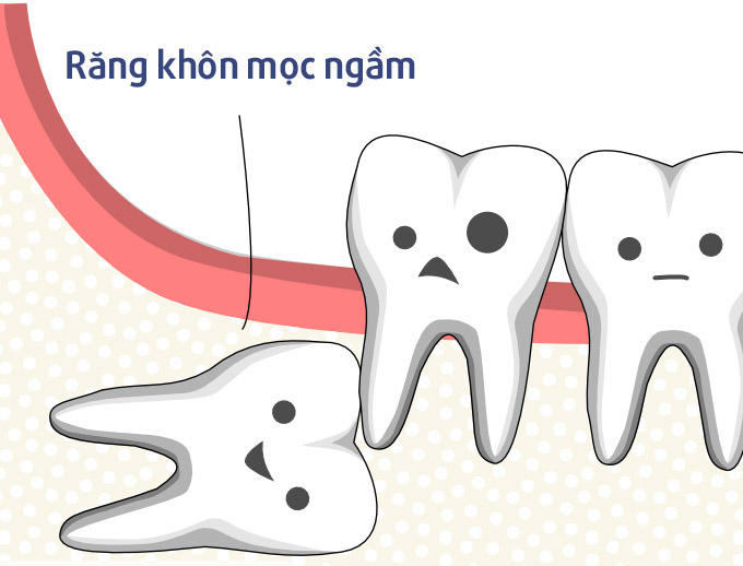 Răng khôn mọc ngầm sâu