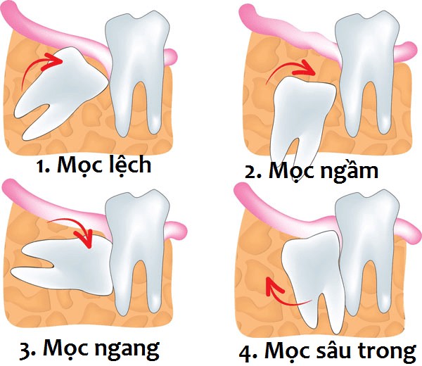 Răng khôn mọc lệch sai vị trí Răng khôn mọc lệch sai vị trí