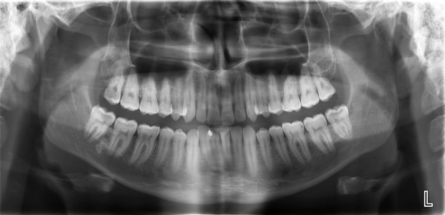 Răng khôn mọc thẳng chuẩn Răng khôn mọc thẳng chuẩn