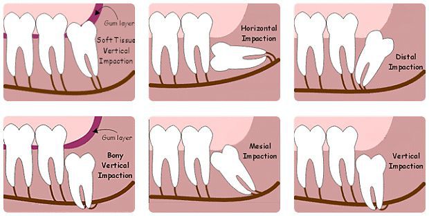 Răng khôn nhổ khó