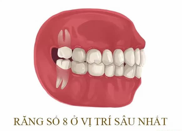 Răng số 8 là răng gì Răng số 8 là răng gì