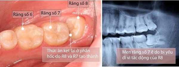 Răng số 8 chèn rang số 7 Răng số 8 chèn rang số 7
