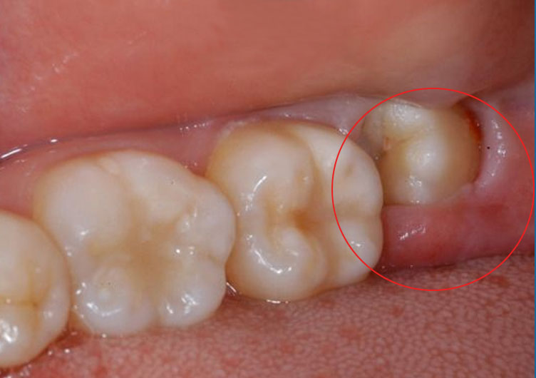 Răng số 8 mọc lệch Răng số 8 mọc lệch