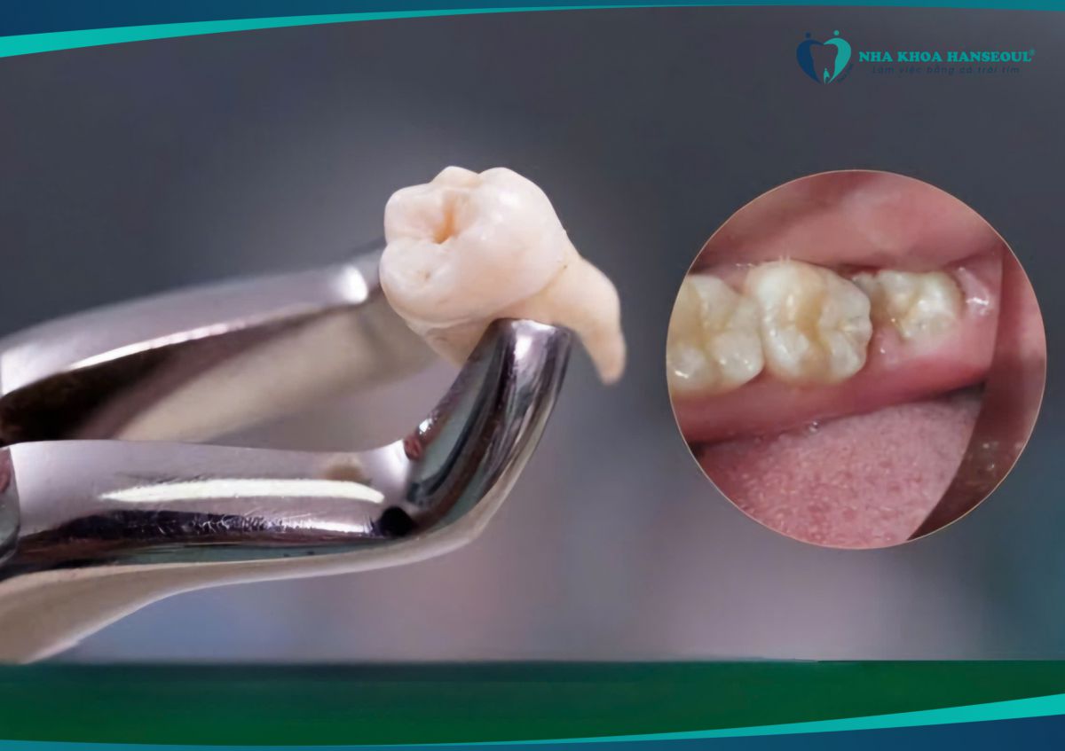 Thực hiện nhổ răng khôn mọc lệch đúng cách sẽ không gây ra đau nhức nhiều cho người bệnh