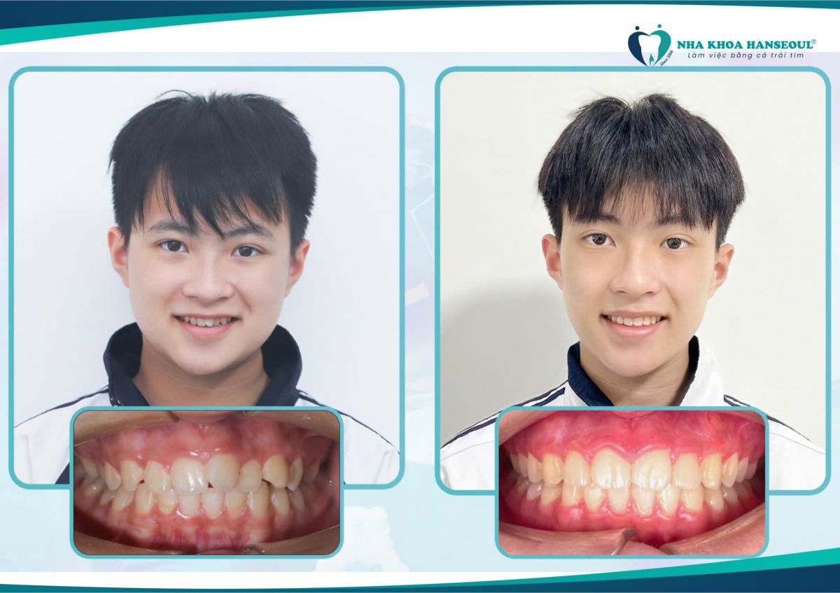 Niềng răng với công nghệ BioSmart tại Nha khoa Hanseoul giúp việc điều chỉnh răng chính xác hơn và giảm thiểu đau đớn.