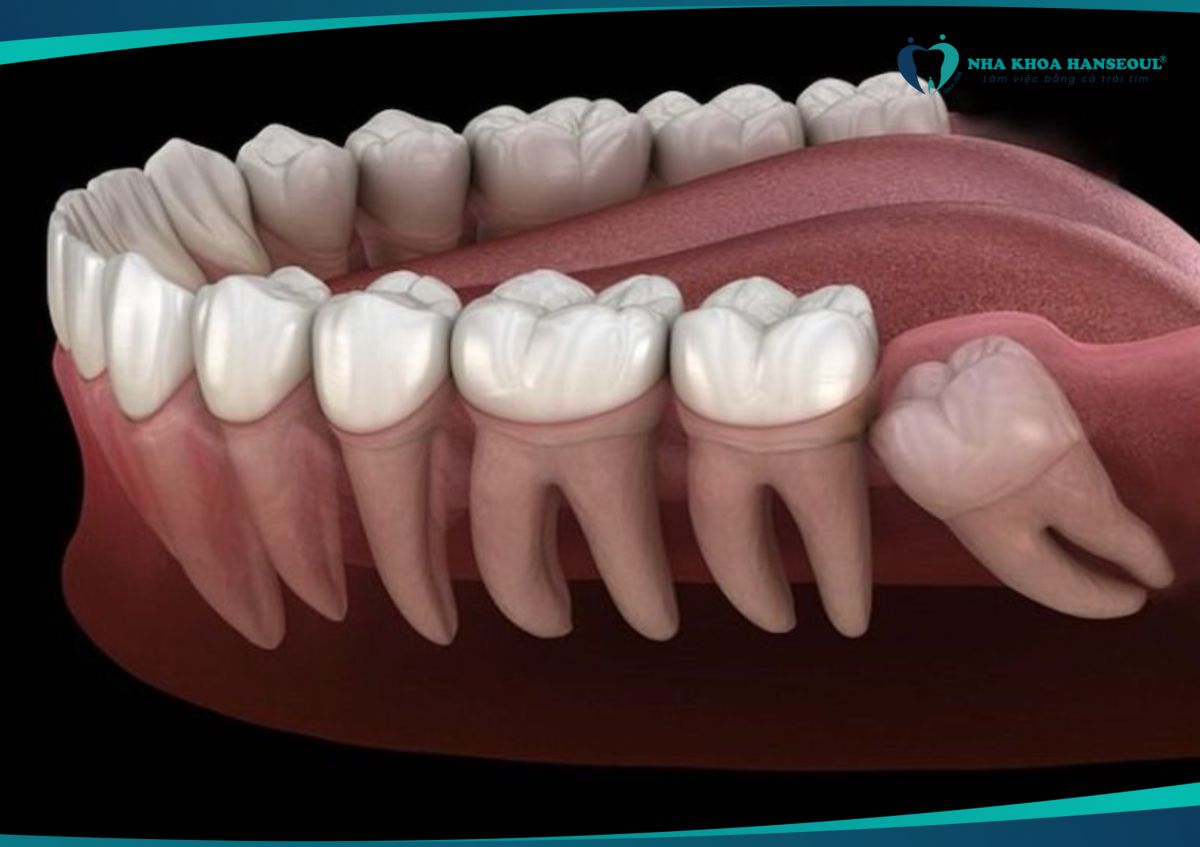 răng khôn mọc lệch