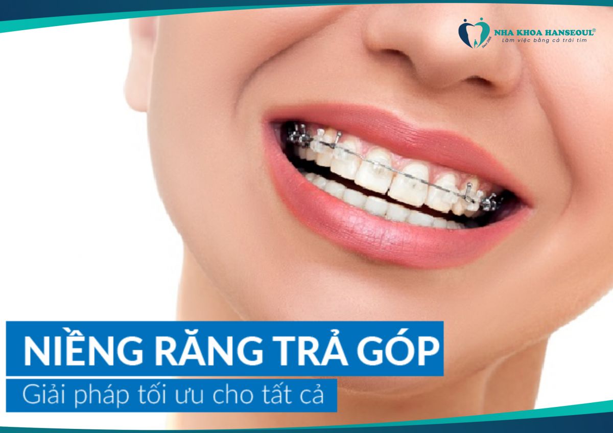 Niềng răng trả góp giúp bạn giảm gánh nặng kinh tế