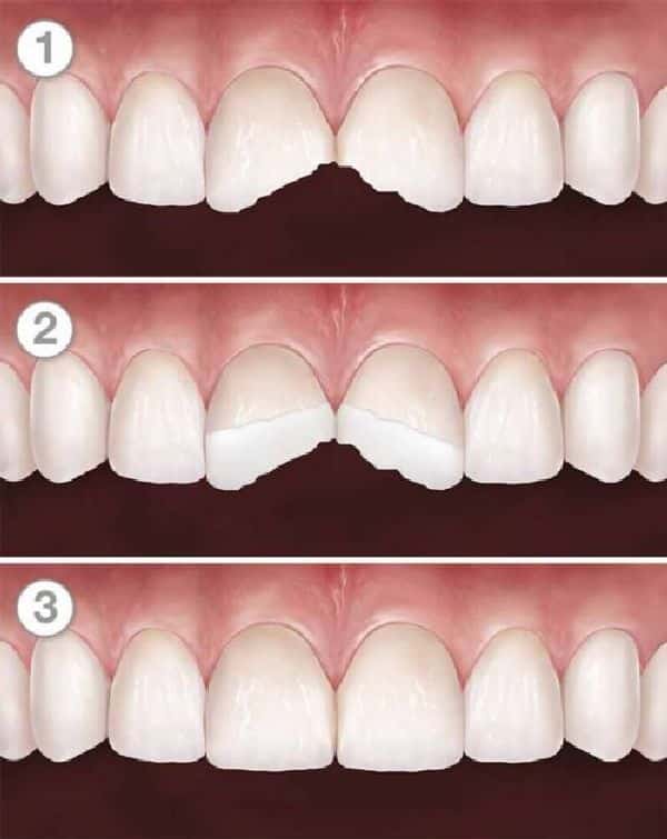 Trám răng cửa Trám răng cửa