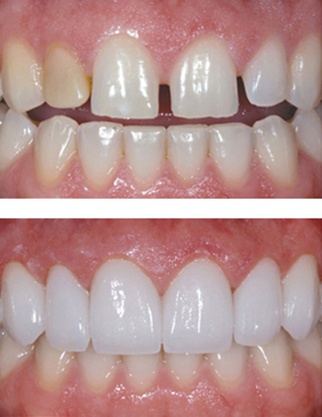 Trám răng thưa Trám răng thưa