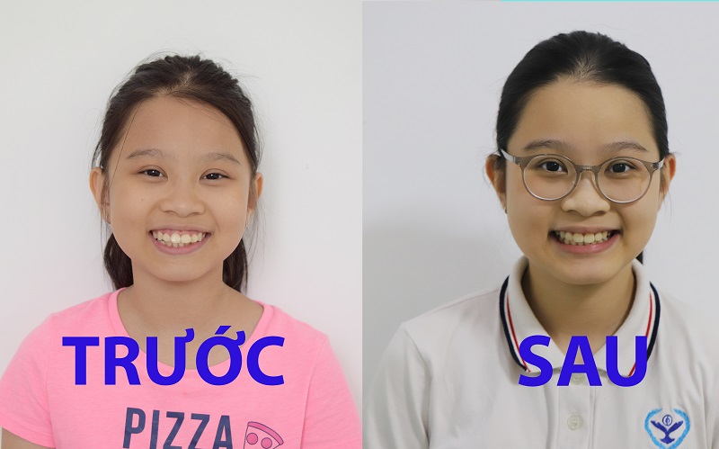 Trước sau khi niềng răng tại Hanseoul Trước sau khi niềng răng tại Hanseoul