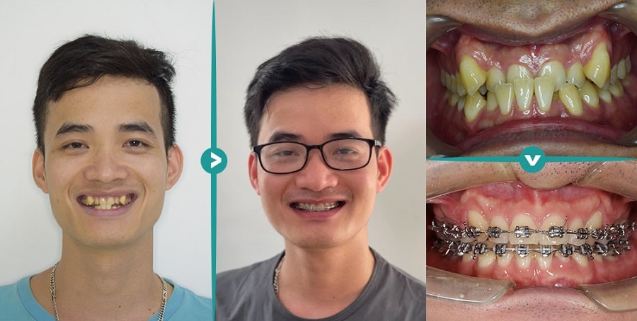 Trước và sau khi niềng tại nha khoa Hanseoul Trước và sau khi niềng tại nha khoa Hanseoul