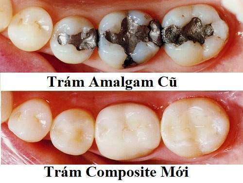 Vật liệu trám Vật liệu trám
