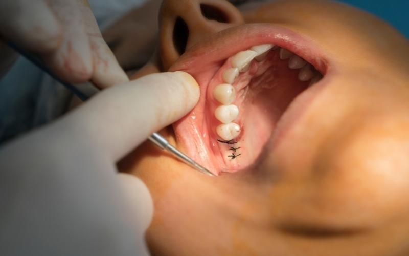 Viêm lợi khi mọc răng khôn nhổ răng khôn kiêng gì