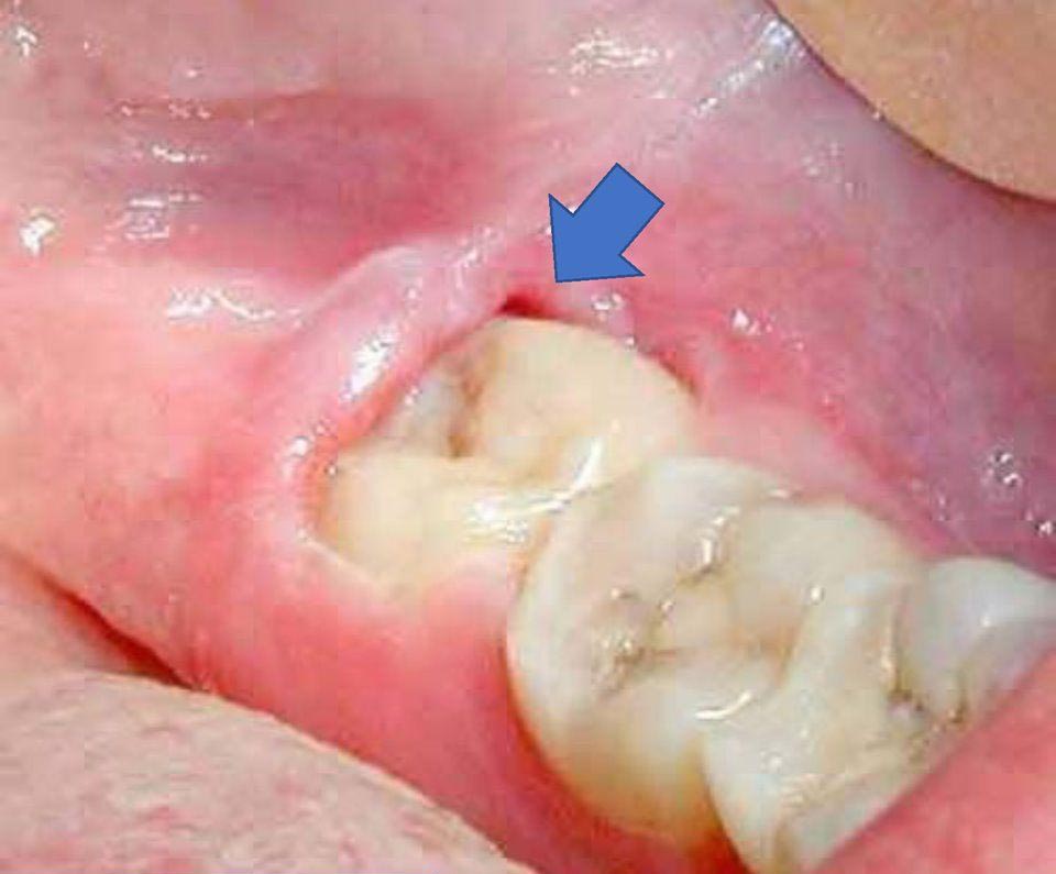 Viêm nha chu do răng khôn Viêm nha chu do răng khôn