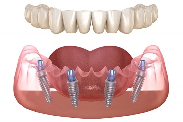 trồng răng implant toàn hàm