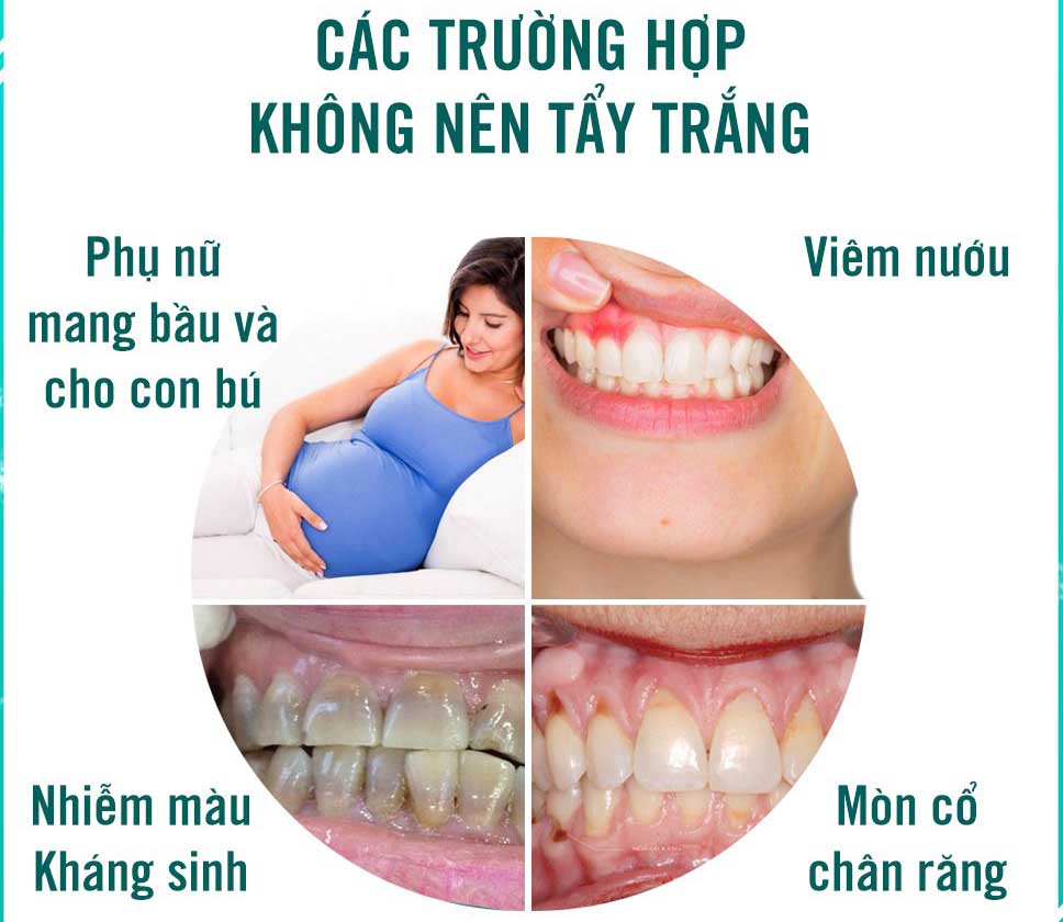 Các trường hợp không nên tẩy trắng răng Các trường hợp không nên tẩy trắng răng