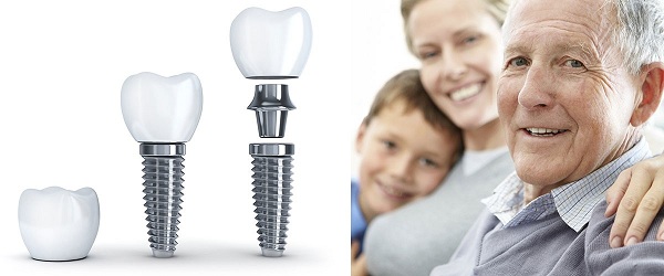 Cấy ghép implant Cấy ghép implant