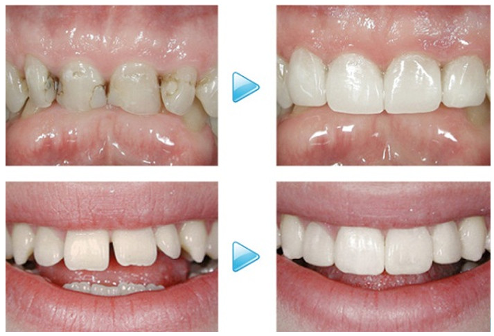 Trám răng cửa thưa Trám răng cửa thưa
