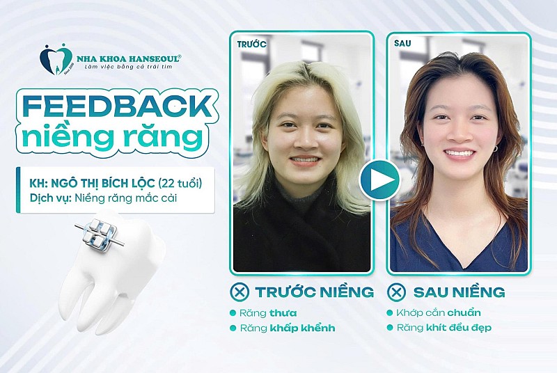 Hành trình thay đổi nụ cười của khách hàng Ngô Thị Bích Lộc (2003) Hành trình thay đổi nụ cười của khách hàng Ngô Thị Bích Lộc (2003)