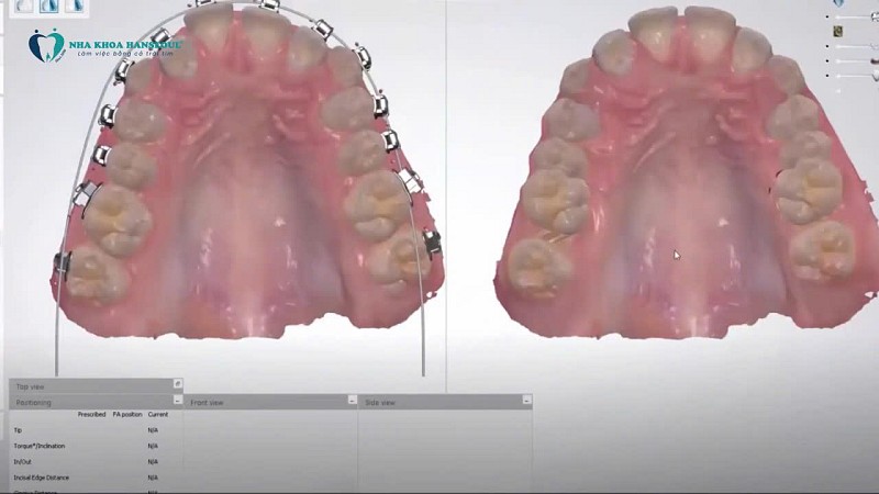 Công nghệ Biosmart trong chỉnh nha Công nghệ Biosmart trong chỉnh nha