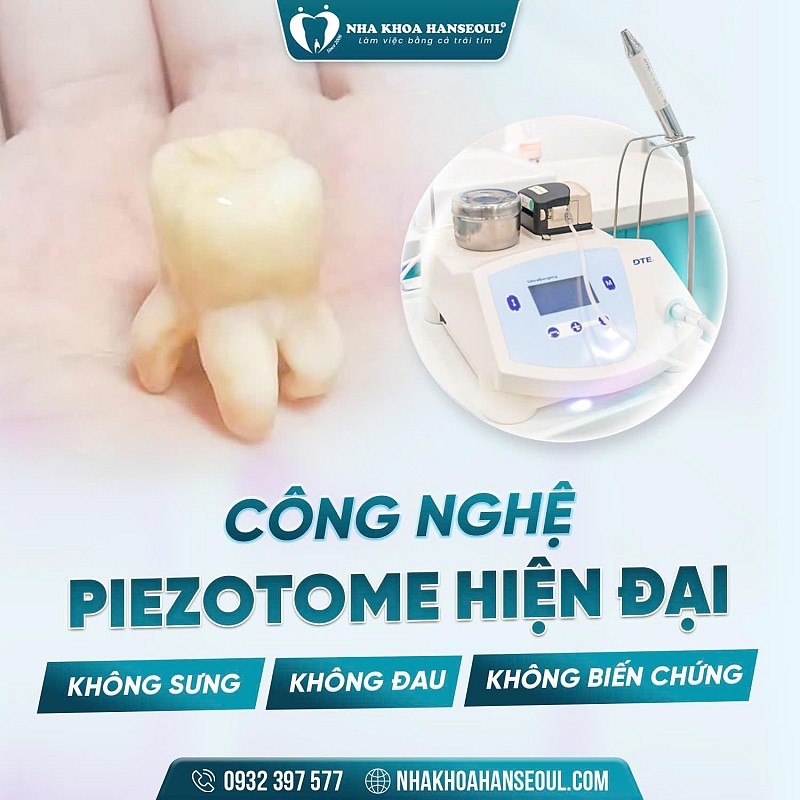 Nhổ răng khôn an toàn, nhẹ nhàng, không đau tại Hạ Long, Quảng Ninh Nhổ răng khôn an toàn, nhẹ nhàng, không đau tại Hạ Long, Quảng Ninh