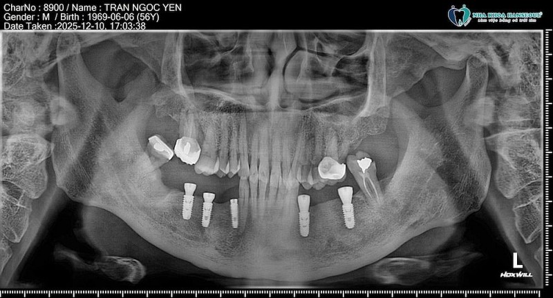 Khôi phục ăn nhai cho chú Trần Ngọc Yên (56 tuổi) với 5 trụ Implant Osstem SA Khôi phục ăn nhai cho chú Trần Ngọc Yên (56 tuổi) với 5 trụ Implant Osstem SA