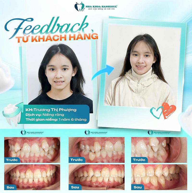 Trương Thị Phượng (2001) và hành trình “lột xác” nụ cười cùng công nghệ BIOSMART tại Hanseoul Trương Thị Phượng (2001) và hành trình “lột xác” nụ cười cùng công nghệ BIOSMART tại Hanseoul